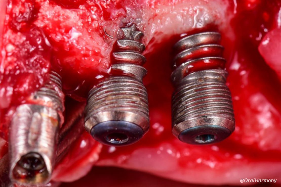 Oral Harmony Implantes Dentales